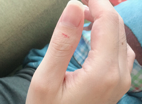 切り傷のある親指